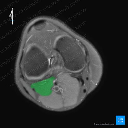 Musculus plantaris (Fußsohlenmuskel); Bild: 