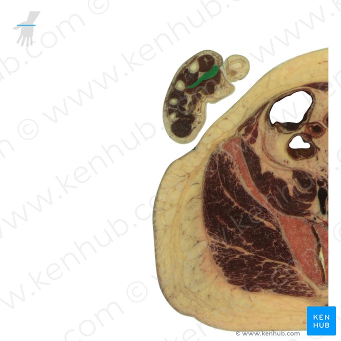 Oblique head of adductor pollicis muscle (Caput obliquum musculi adductoris pollicis); Image: National Library of Medicine
