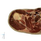 Cross sections of the upper extremity: Shoulder level