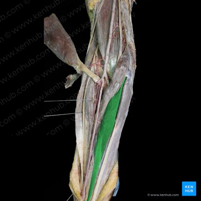 Musculus flexor carpi radialis (Speichenseitiger Handbeuger); Bild: 
