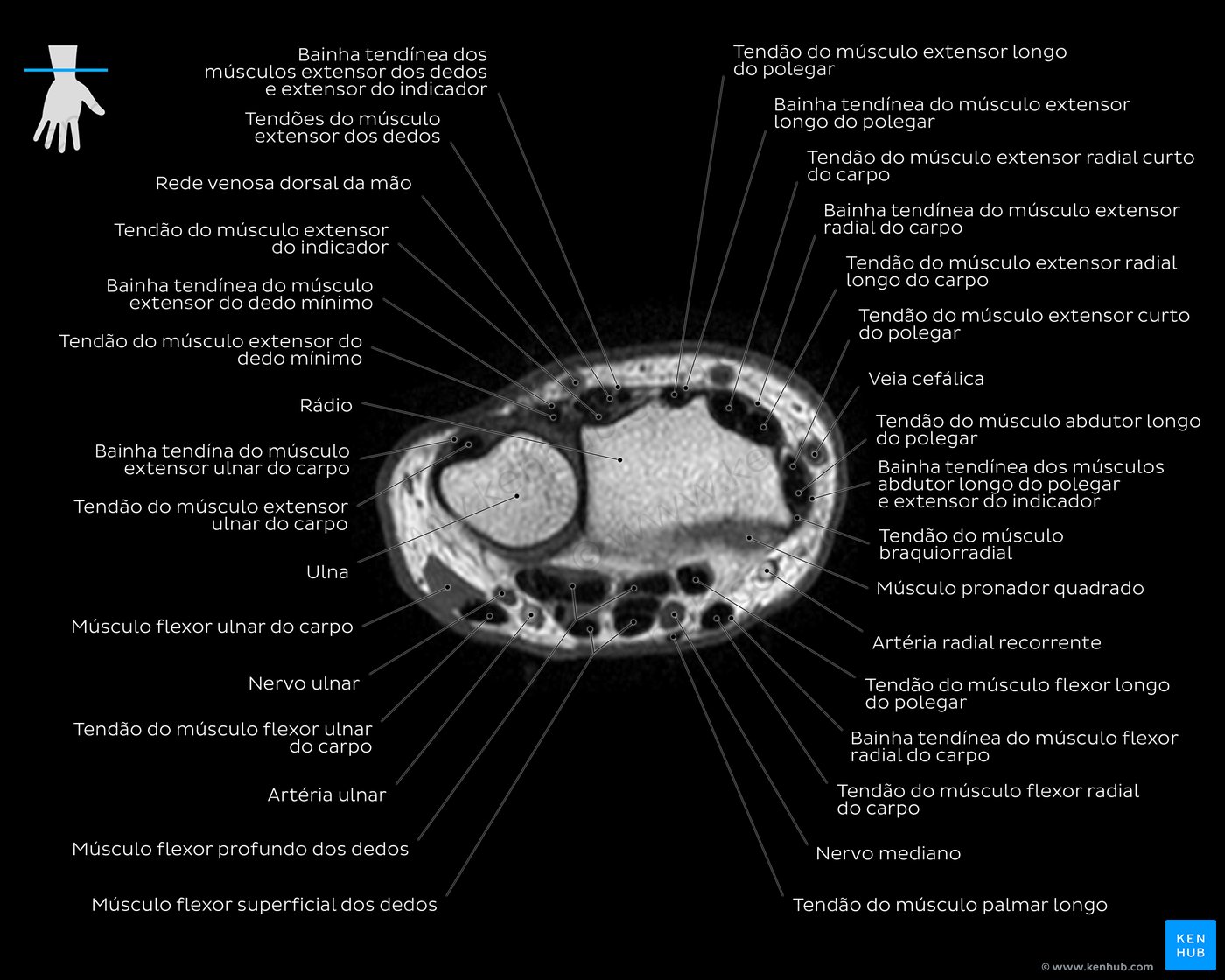 Imagem de ressonância magnética ponderada em T1 ao nível do tendão do extensor ulnar do carpo