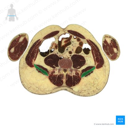 Ílio (Os ilium); Imagem: National Library of Medicine