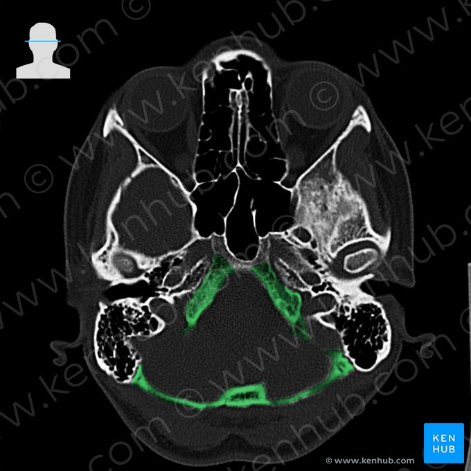 Osso occipital (Os occipitale); Imagem: 