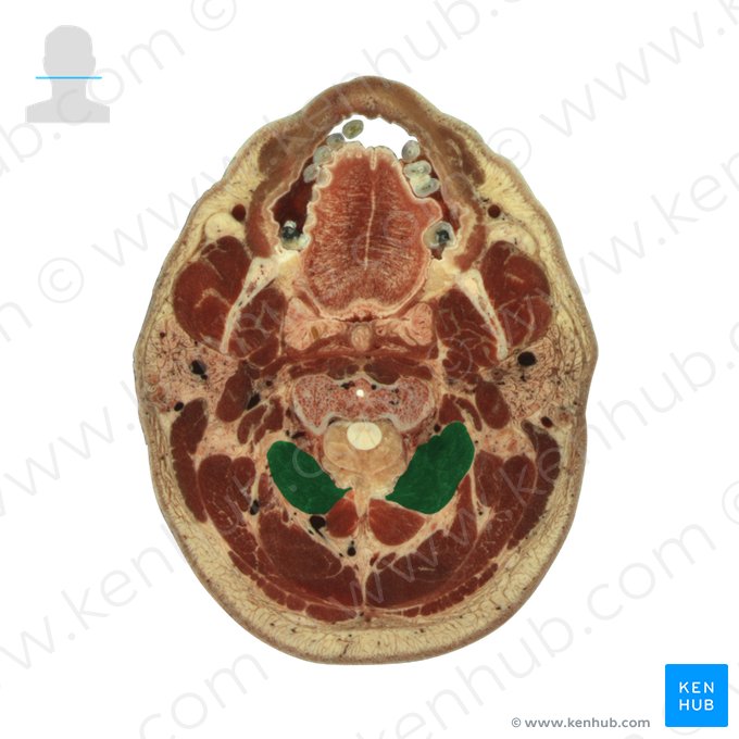 Músculo oblíquo inferior da cabeça (Musculus obliquus capitis inferior); Imagem: National Library of Medicine