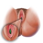Vaginal orifice