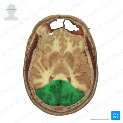 Occipital lobe (Lobus occipitalis); Image: National Library of Medicine