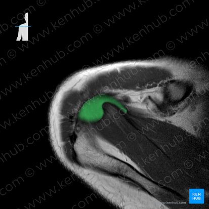 Tendon of supraspinatus muscle (Tendo musculi supraspinati); Image: 