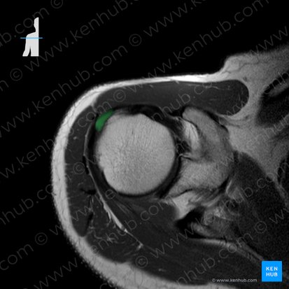 Tendo musculi supraspinati (Sehne des Obergrätenmuskels); Bild: 