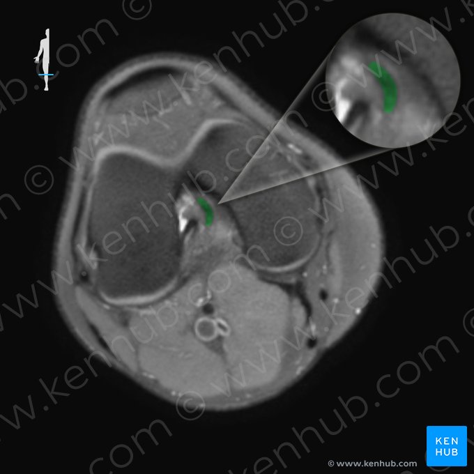 Ligamentum meniscofemorale posterius (Hinteres Meniskus-Oberschenkelknochen-Band); Bild: 