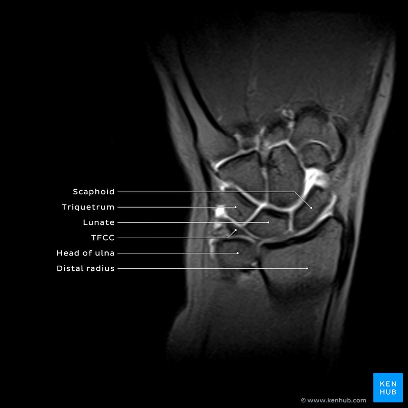 Distal radioulnar joint MRI