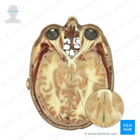 Third ventricle (Ventriculus tertius); Image: National Library of Medicine
