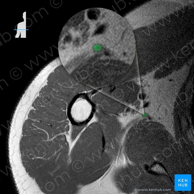 Thoracodorsal artery (Arteria thoracodorsalis); Image: 