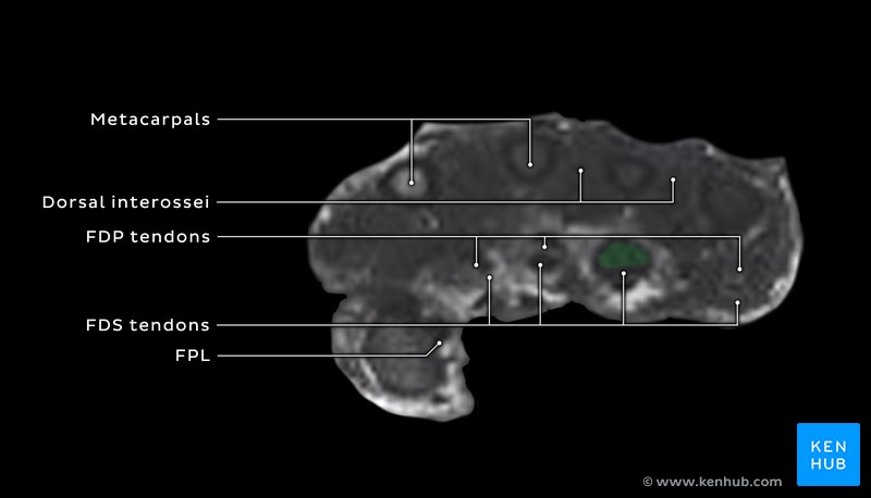 Axial T2 MRI of the right hand