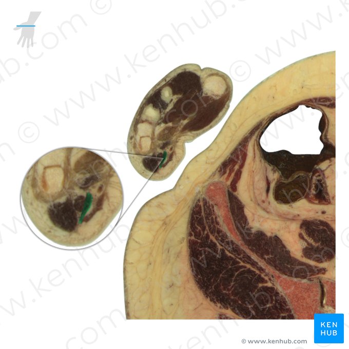 Musculus flexor digiti minimi brevis manus (Kleinfingerbeuger); Bild: National Library of Medicine