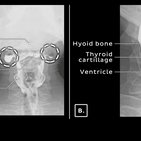 Clinical case: Pharyngeal diverticula