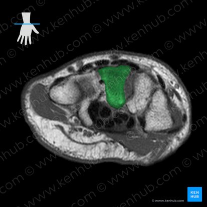 Capitate bone (Os capitatum); Image: 