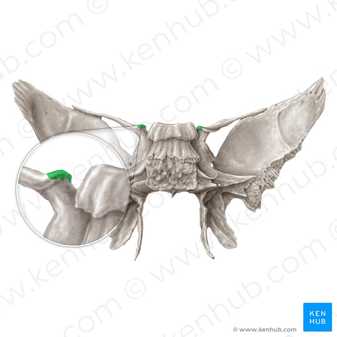 Processo clinoide anterior do osso esfenoide (Processus clinoideus anterior ossis sphenoidalis); Imagem: Samantha Zimmerman