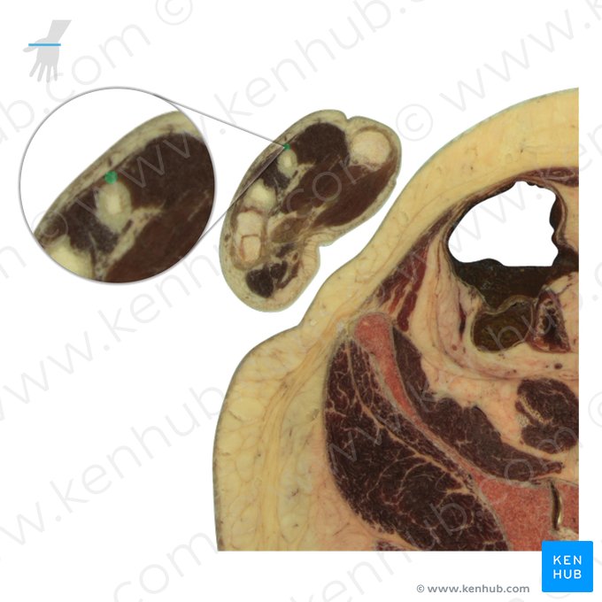 Tendão do músculo extensor do indicador (Tendo musculi extensor indicis); Imagem: National Library of Medicine