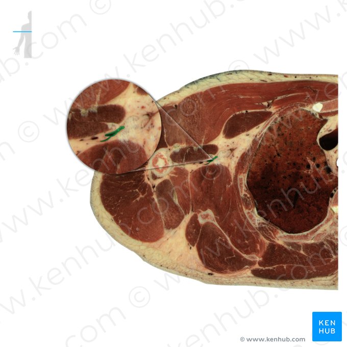 Axillary artery (Arteria axillaris); Image: National Library of Medicine