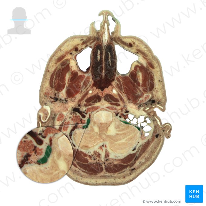 Seio sigmoide (Sinus sigmoideus); Imagem: National Library of Medicine