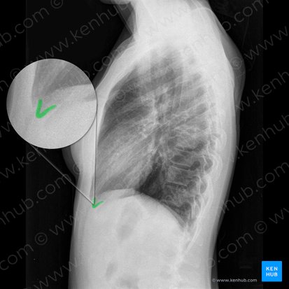 Left anterior costophrenic angle (Angulus costophrenicus anterior sinister); Image: 