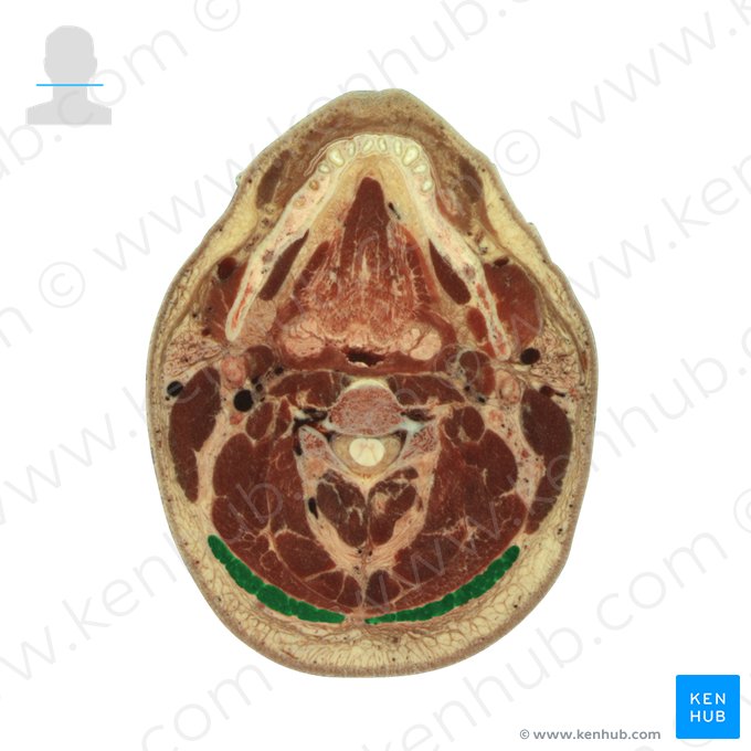 Músculo trapézio (Musculus trapezius); Imagem: National Library of Medicine