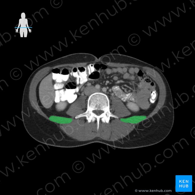 Musculus quadratus lumborum (Viereckiger Lendenmuskel); Bild: 