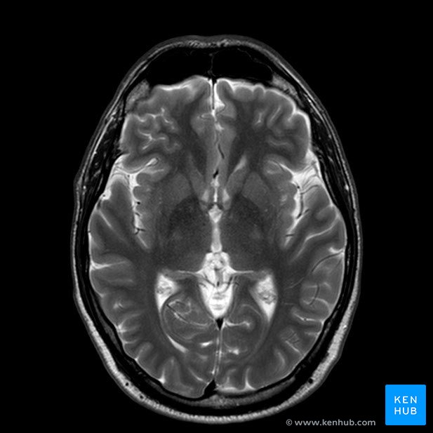 Normal brain MRI
