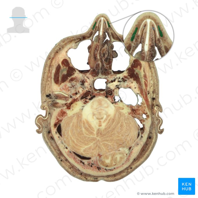 Nasalis muscle (Musculus nasalis); Image: National Library of Medicine