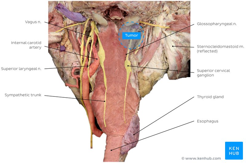 Figure 5 - Cadaver image - Posterior Wall of the Pharynx - Anterior View