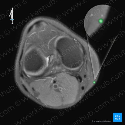 Great saphenous vein (Vena saphena magna); Image: 