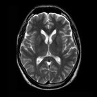 Brain (MRI)