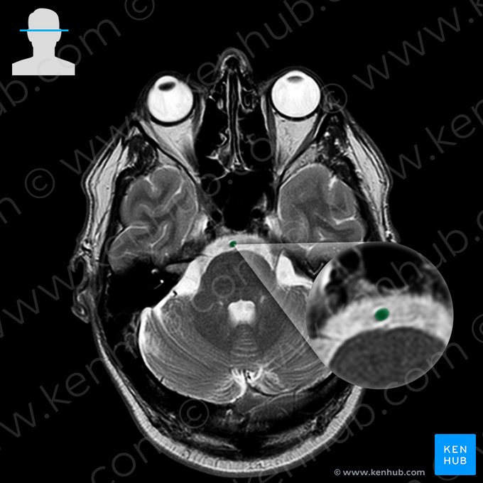 Basilar artery (Arteria basilaris); Image: 