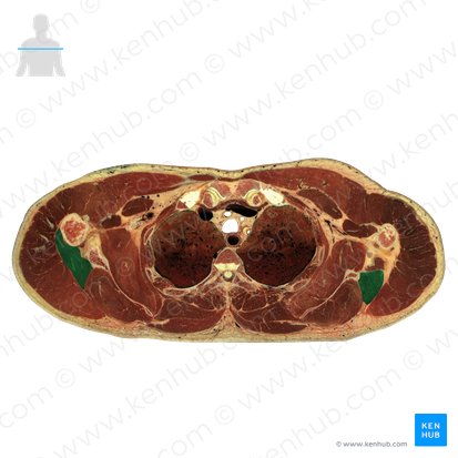 Musculus teres minor (Kleiner Rundmuskel); Bild: National Library of Medicine